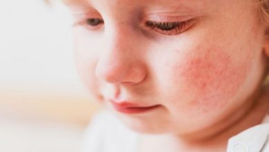 Photo of La dermatitis atópica afecta de manera notable a la calidad de vida de los niños