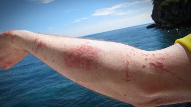 Photo of Salud recuerda que las picaduras de medusa son leves en la mayoría de los casos
